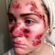 Illustration for article titled Woman's Shocking Selfie Shows What Skin Cancer From Tanning Looks Like